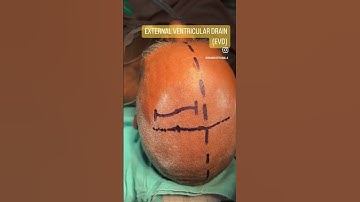 External ventricular drain EVD| Cerebrospinal fluid tapping| MOST COMMON & LIFE SAVING NEUROSURGERY