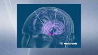 Deep Brain Stimulation Second operation - Stimulator Procedure