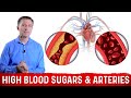The Effects of High Blood Sugar On Arteries – Dr.Berg on Arteriosclerosis & Atherosclerosis