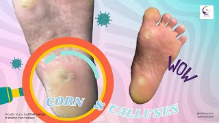 Multiple THICK Corn and Calluses from sole of foot!