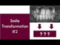 Smile Transformation #2 | Dr. Jiten Vadukul | The Orthodontist