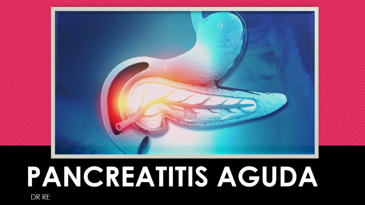 PANCREATITIS AGUDA ENARM (GPC 2023)