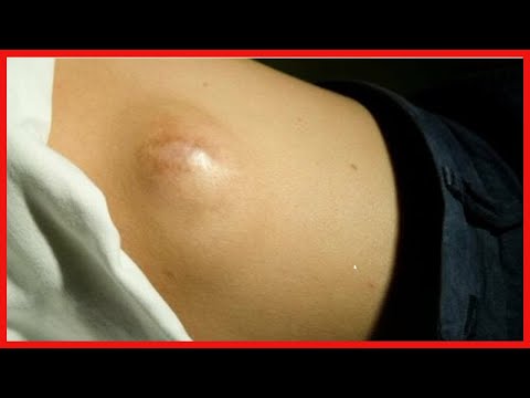 Video: Was ist myxoides Fibroadenom?