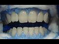 Clareamento dental  como clarear os dentes do jeito certo