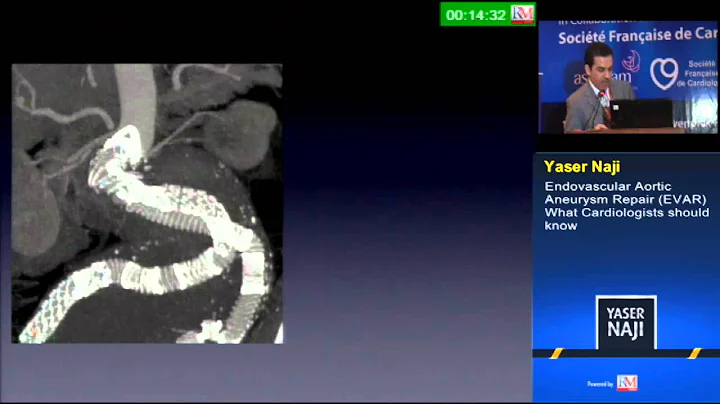 Endovascular Aortic  Aneurysm Repair (EVAR) What Cardiologists should  know
