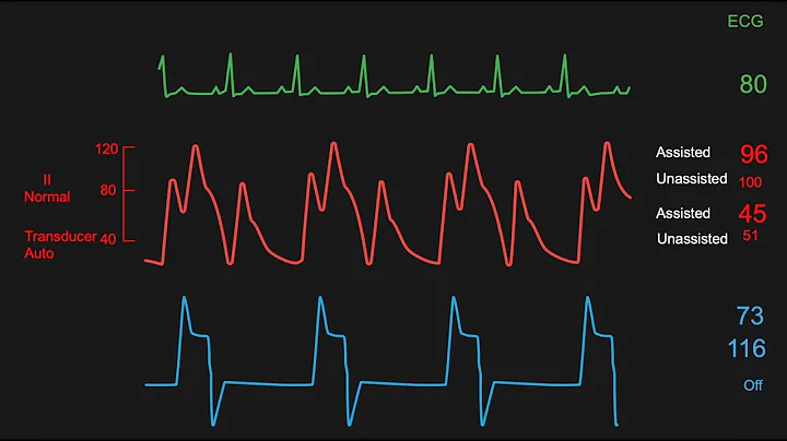 Interpreting the data displayed on a balloon pump console monitor