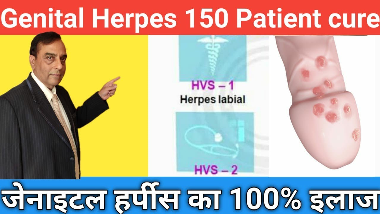 How To Cure Genital Herpes L HSV1 Positive And HSV2 Positive Cure 100 How To Cure Genital Herpes L HSV1 Positive And HSV2 Positive Cure 100