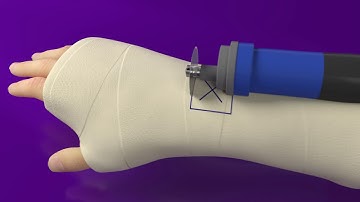 Exogen In Cast Square Pad Only