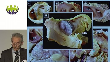 Claudio Tondo - Is there a role for 3D printing in LAA Occlusion procedures?