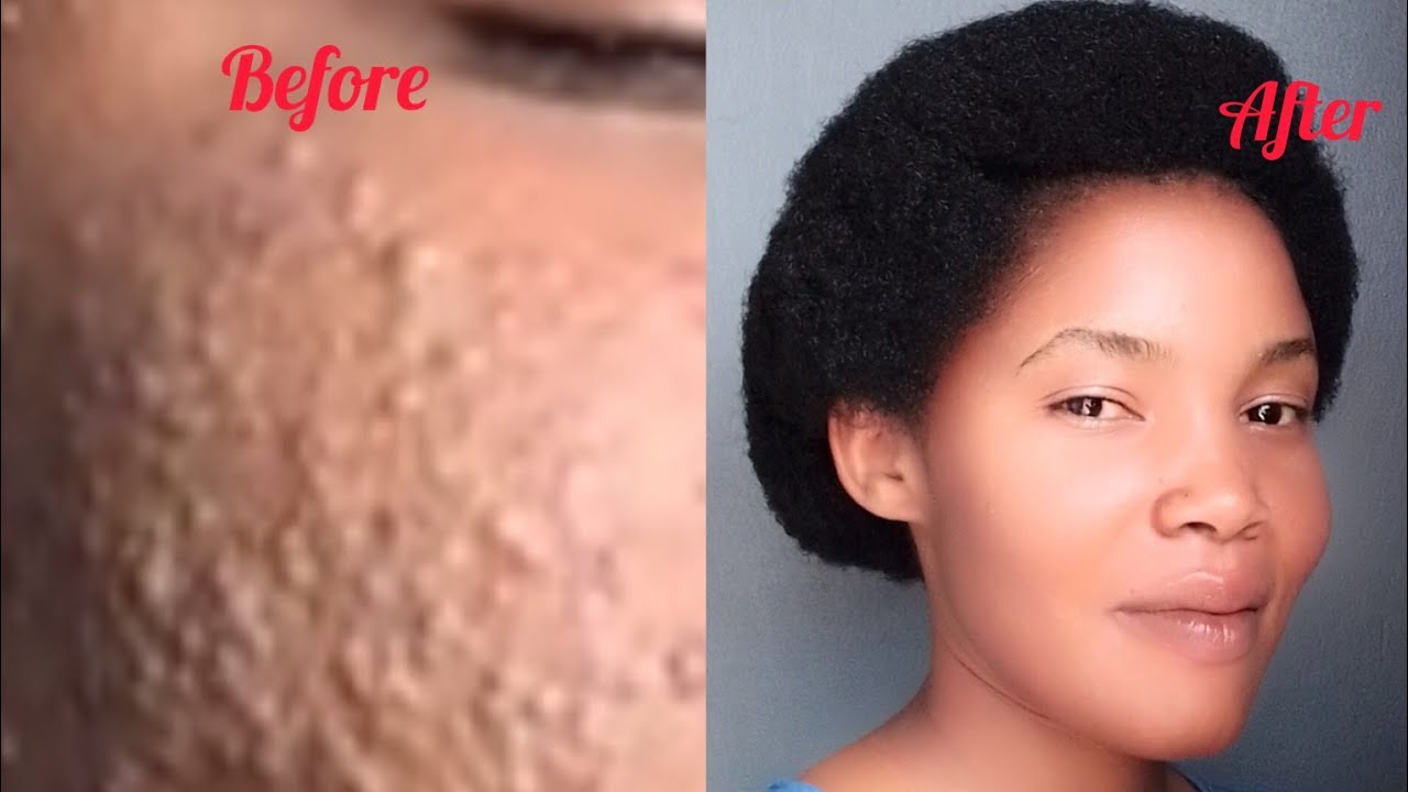 Isabune eshatu nziza zihendutse cyane zizewe mugukiza ibiheri namatache ...