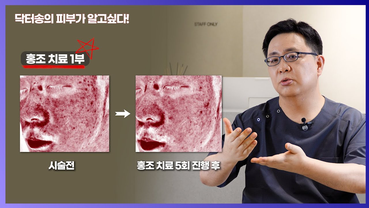 안면홍조 치료 꼭 짚고넘어가기 1부/ 홍조치료 못다한 이야기/홍조치료 별표 밑줄 쫙! - YouTube