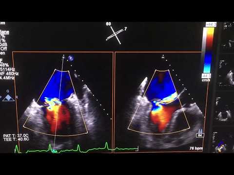 Mitral valve prolapse with severe mitral regurgitation (TTE &TEE) - YouTube