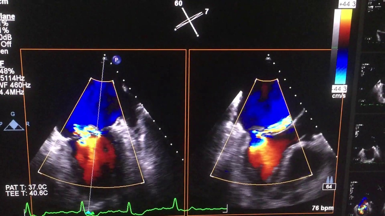 Mitral valve prolapse with severe mitral regurgitation (TTE &TEE) - YouTube