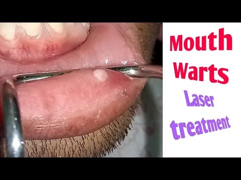 Mouth Wart removed with Lasers/Oral Verruca Vulgaris and its treatment with Lasers||Dental Issues||