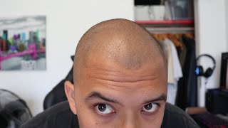 My SMP Scalp Micropigmentation before and after