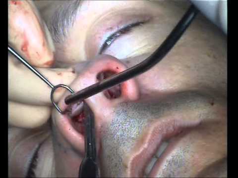 Rinoplastia - operacion nariz. Clinica Ruber Dr.Al...