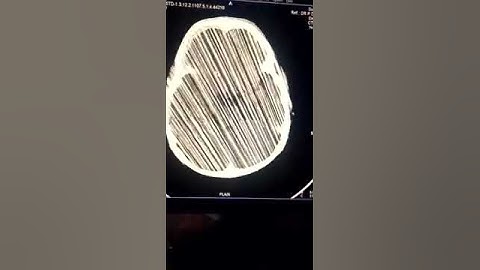 Artifact in CT scan images(7)