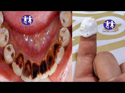 Finally i get the solution for Magical teeth whitening Remedy , Get whiten teeth at home in 2 minute