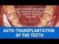 How to autotransplant the human teeth