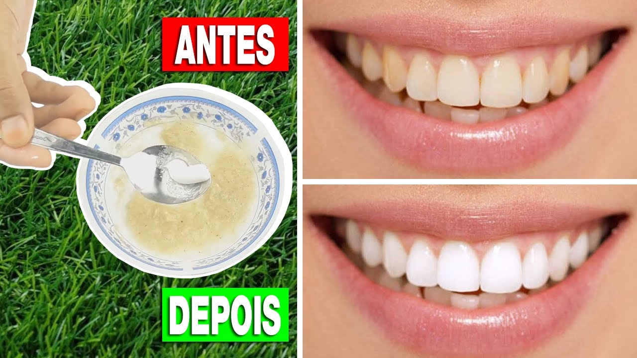 Limpiar férula dental bicarbonato