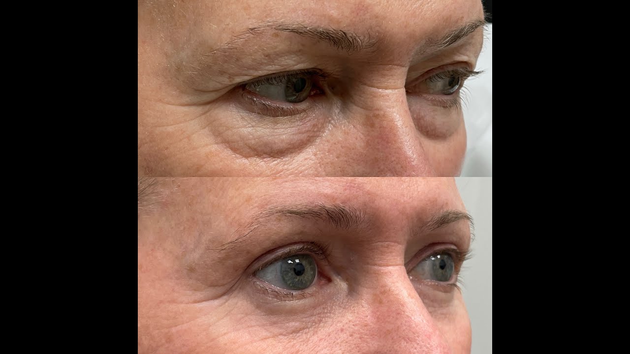 What is Blepharoplasty YouTube