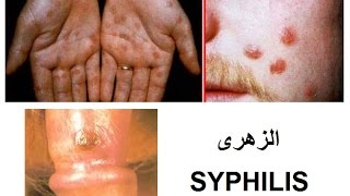 الزهرى : تعريفه أسبابه - أعراض الزهرى وعلاج الزهرى - Syphilis