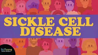 Sickle Cell Disease (SCD): A Neglected Global Health Burden