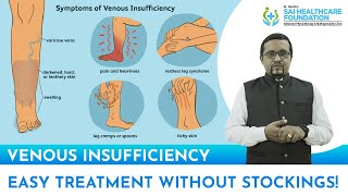 Venous insufficiency | Easy treatment | Dr. Harish Kumar