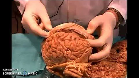 Cosa succede se si spezza il midollo spinale?