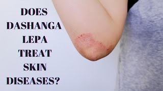 Dashanga Lepa - Benefits, How to use, Ingredients, Side effects