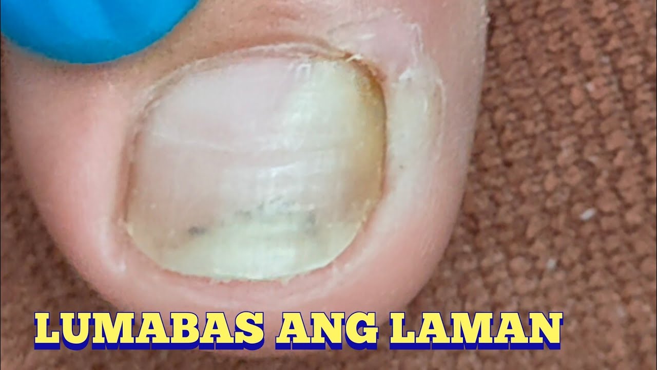 TOENAIL BRITTLE DUE TO FUNGUS YouTube