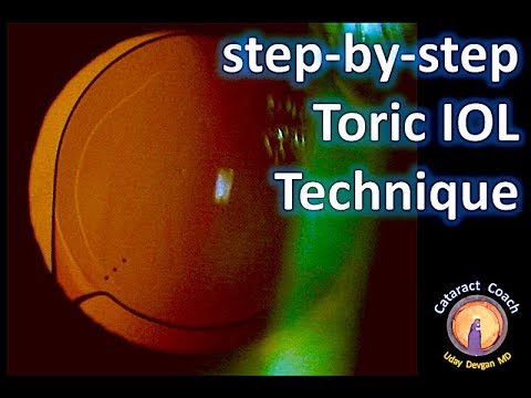 Step-by-Step Technique for Toric IOLs - Beautifully performed cataract surgery