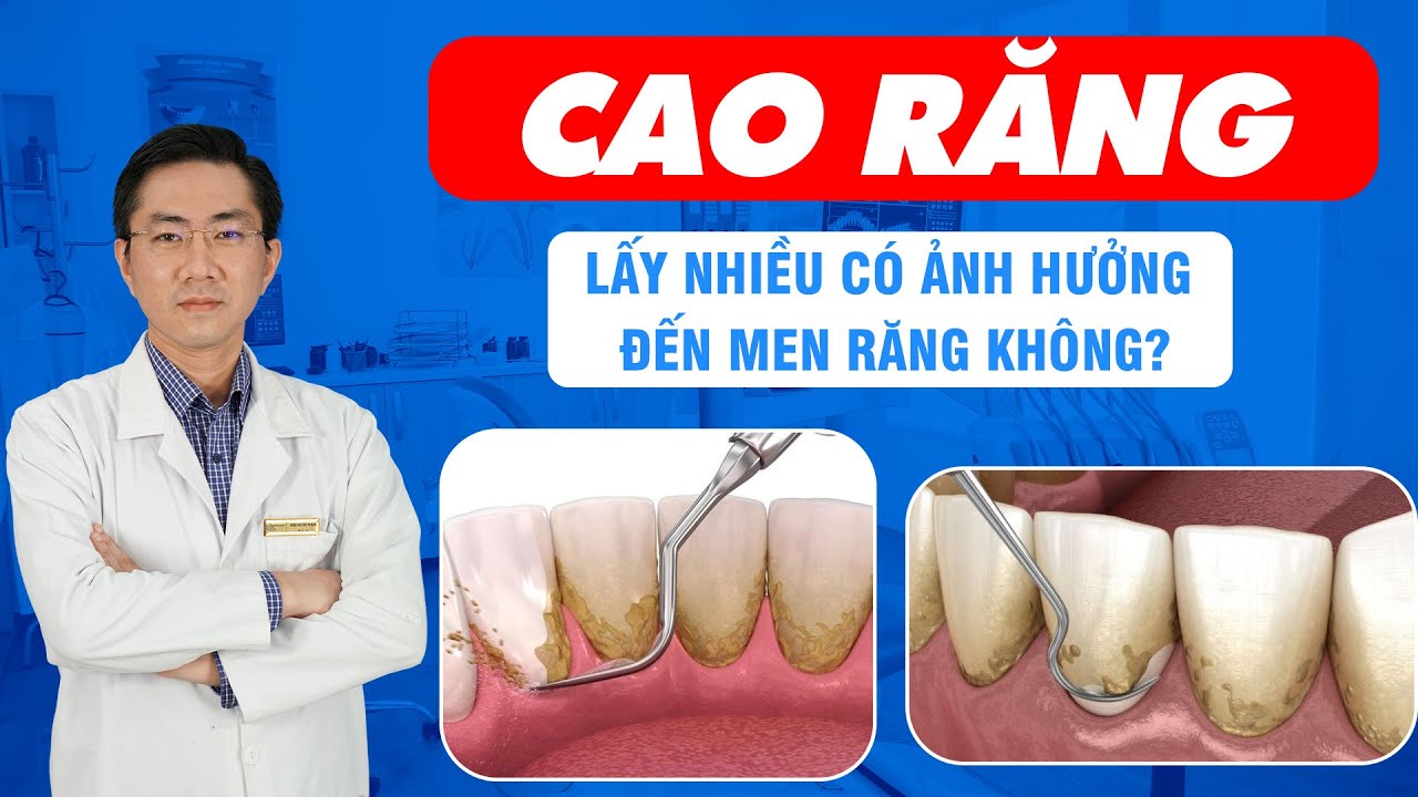Outline Video Cao Răng - Lấy Nhiều Có Ảnh Hưởng Đến Men Răng Không? | Nam Bùi Vinalign