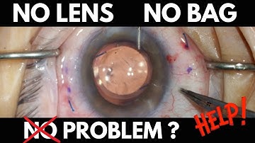 Can we fix it? | Kim-Modified Yamane Technique after Complex Cataract Removal | ISHF