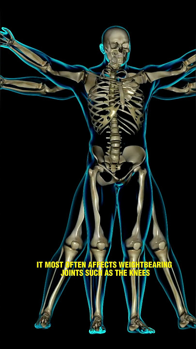 What is osteoarthritis?#Osteoarthritis#JointPain#ArthritisAwareness#BoneHealth#JointHealth