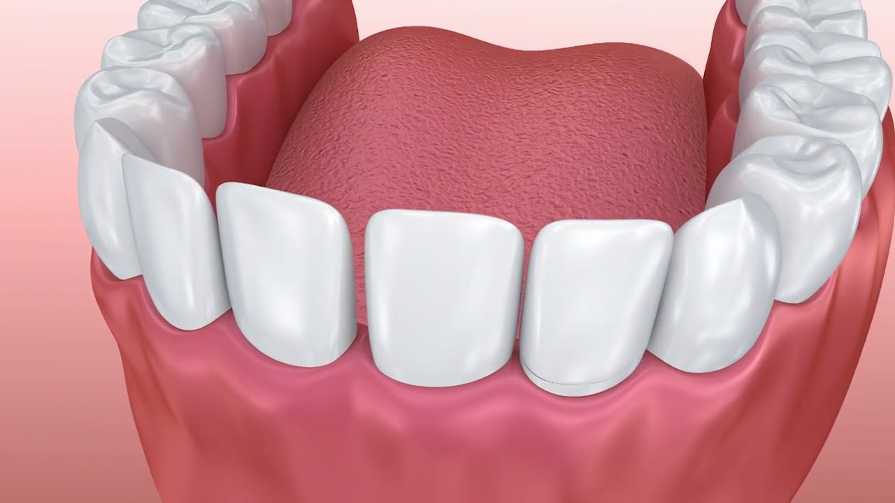 Dental Veneers - Ipswich Dental Surgery