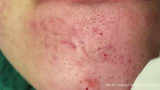 Big Cystic Acne Blackheads Extraction Blackheads & Milia, Whiteheads Removal Pimple Popping