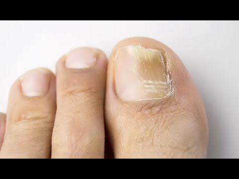 Видео: ★★ Лечение грибка ногтей. Противогрибковые препараты от онихомикоза. Лаки от грибка ногтей.