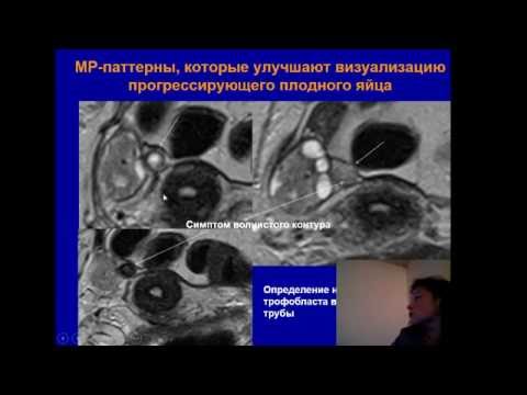 Доклад: "Неотложная МР-диагностика внематочной беременности"