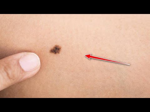 Βίντεο: Πώς να αναγνωρίσετε τον καρκίνο του δέρματος: 12 βήματα (με εικόνες)