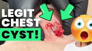 LEGIT CHEST CYST!