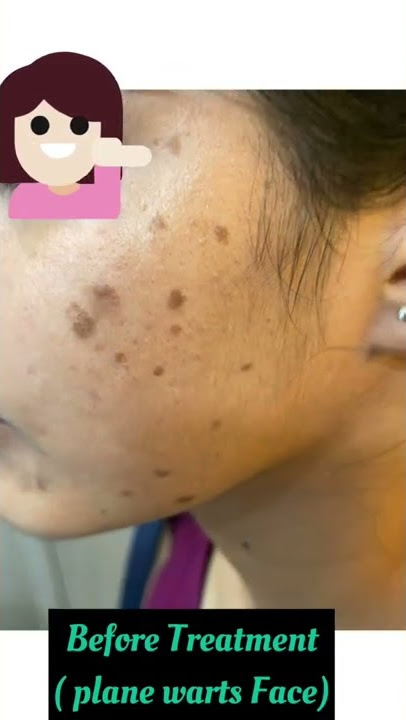 Tretinoin cream |plane warts on face| Does tretinoin works for plane warts alone or with medication