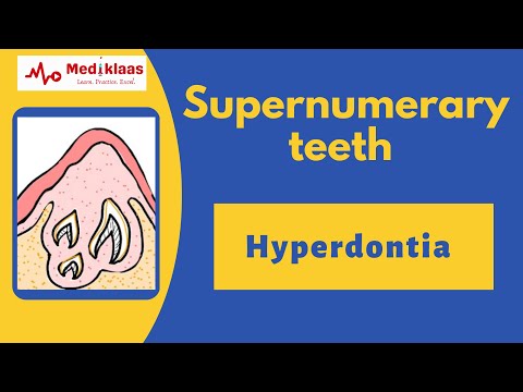 Supernumerary teeth