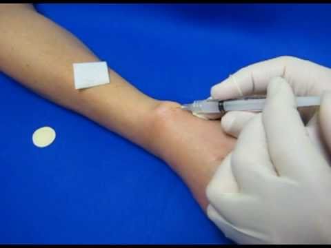 De quervain's steroid injection video
