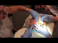 Threadlift Procedure June 2018