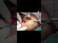 Dental Implants Placement.#dentalimplants #m #mohalidentist #healthysmile #chewing #nobelbiocare