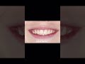 Braces used to look bulky, now they don't have to.
