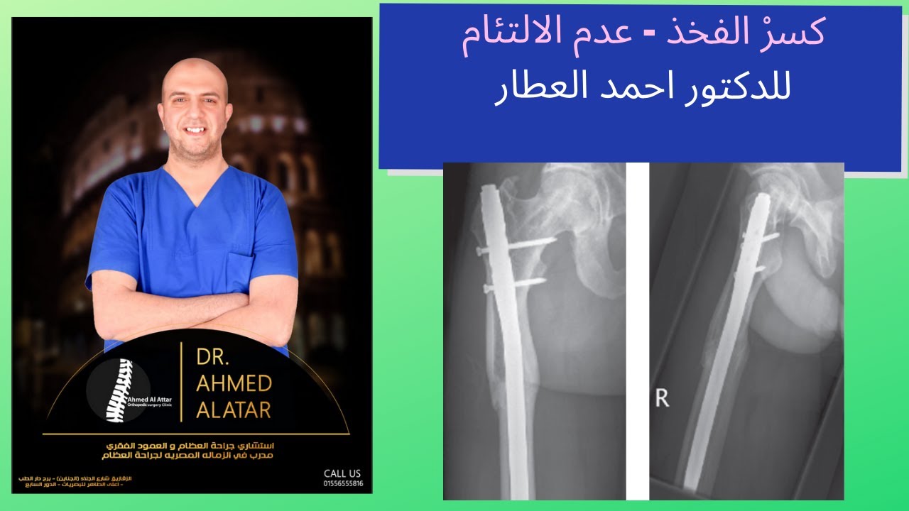 كسرْ الفخذ وعدم الالتئام