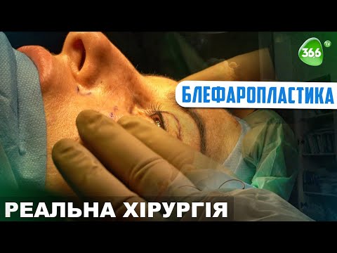 Блефаропластика. Як Зберегти Молодість Ваших Очей?