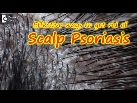 Scalp psoriasis:Symptom, Cause, Treatment | Safe ways to Wash Hair -Dr. Rasya Dixit| Doctors&rsquo; Circle